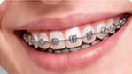 Orthodontic Treatment
